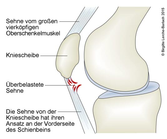 Patella-Tendinopathie (Jumper's Knee)