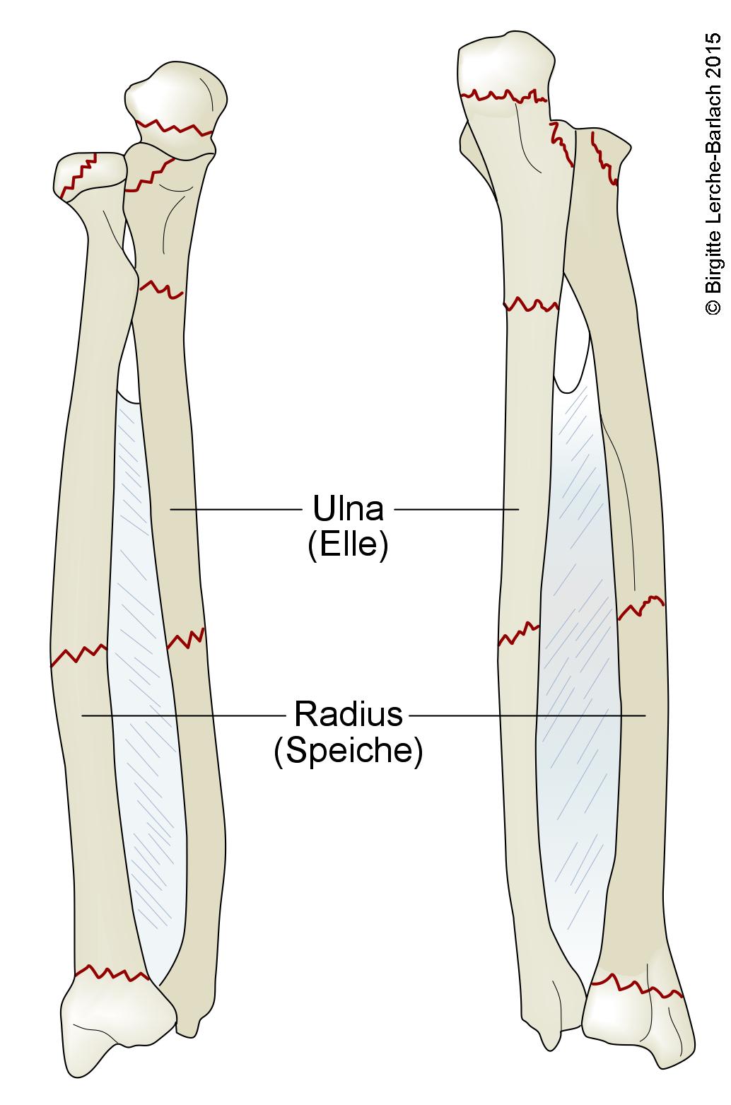 Radius- und Ulnafraktur