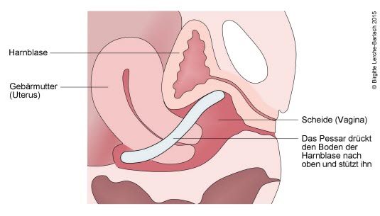 Der Pessar-Ring hebt und fixiert den Blasenboden.