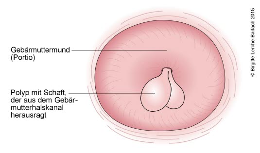 Zervixpolypen