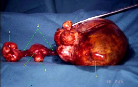 Bilaterale Fibrome, Operationspräparat