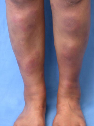 Erythema nodosum