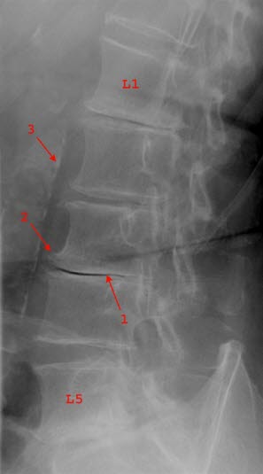 Spondylose und Bandscheibendegeneration