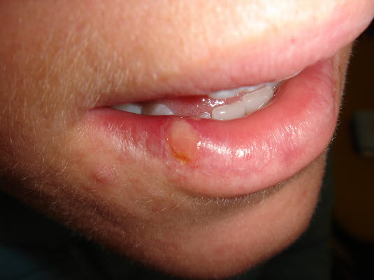 Herpes simplex auf der Lippe, Frühphase