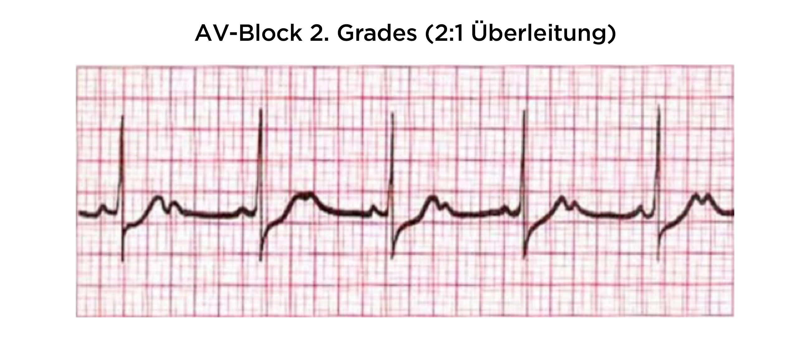 AV-Block 2. Grades, Typ Mobitz