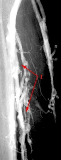 Tiefe Venenthrombose, Venografie