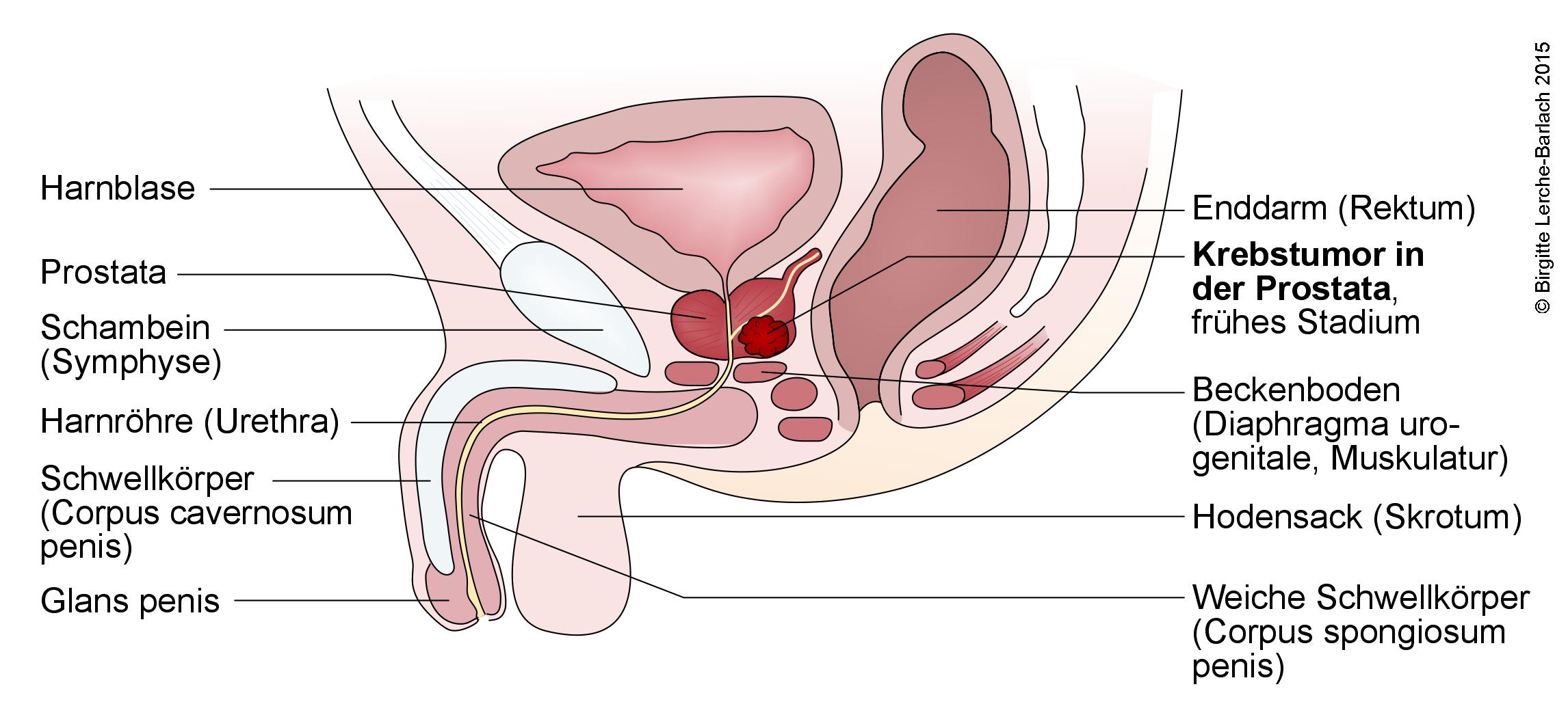 Prostata Krebstumor.jpg