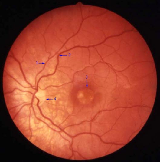 Beginnende Makuladegeneration: 1+2 Netzhautgefäße; 3 Makula; 4 Papille
