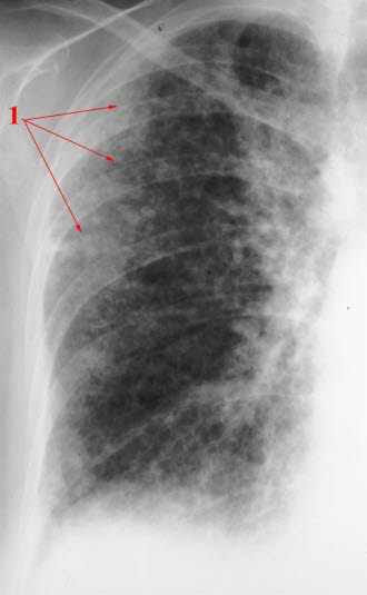 Lungenfibrose, Röntgen