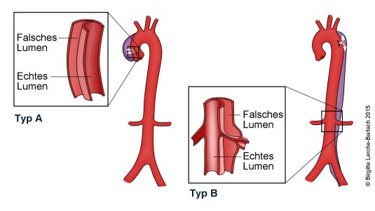 Aortendissektion