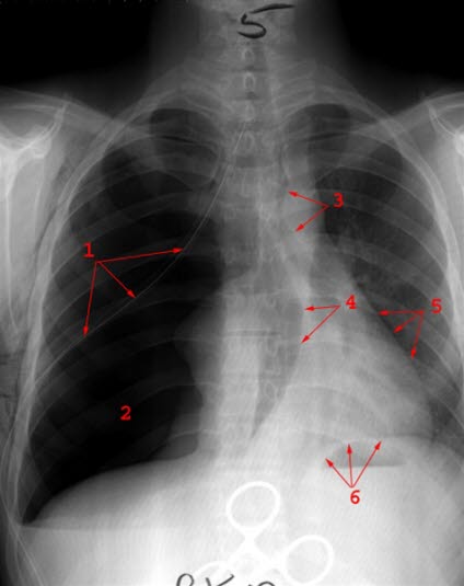 Spannungspneumothorax. Überblähte rechte Lunge mit sichtbarer Pleura visceralis (1) und Mediastinalverlagerung zur gesunden Seite (Verschiebung der Herz- und Tracheasilhouette = 3,4,5). Tiefstehendes Zwerchfell auf der betroffenen Seite. 6= linkes Zwerchfell.