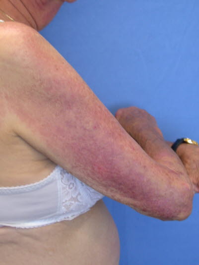 Dermatomyositis