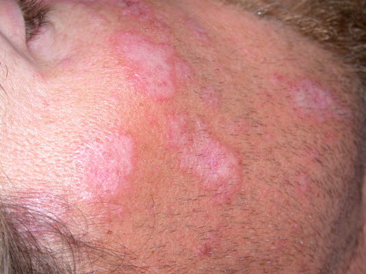 Diskoider Lupus erythematodes: atrophe Narben mit aktivem, geröteten und hyperpigmentiertem Randsaum. 