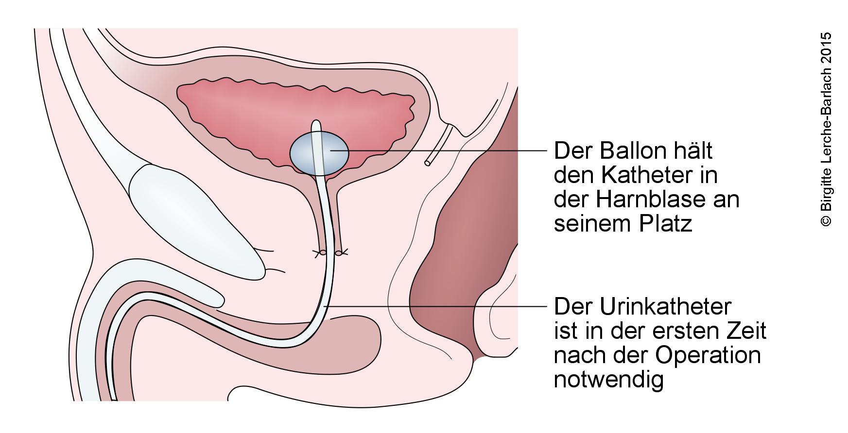 Entfernte Prostatadru¦êse.jpg