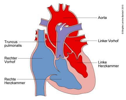 682-persistierender-ductus-arteriosus.jpg