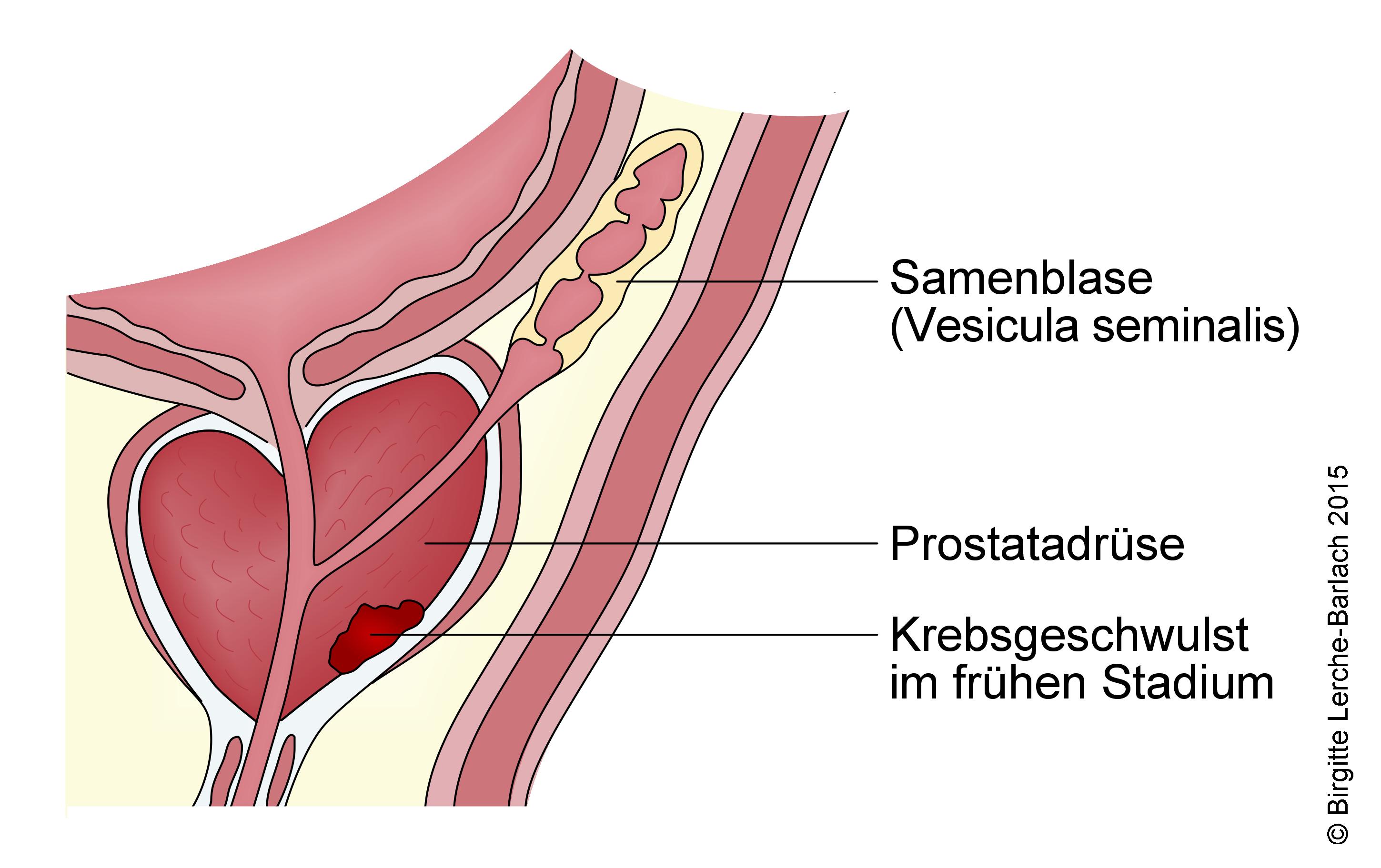 Prostatakrebs, Stadium 1.jpg