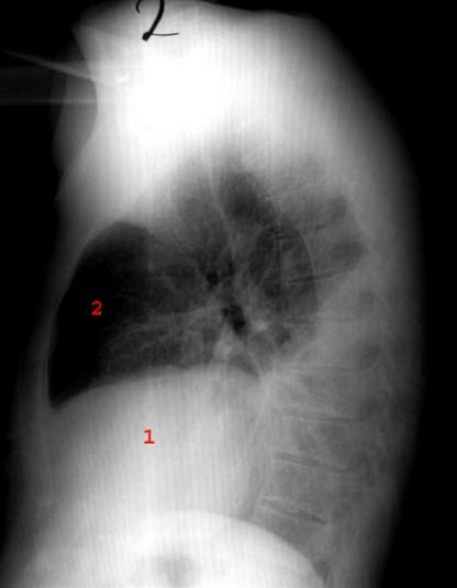 Pleuropneumonie, Seite, Röntgen