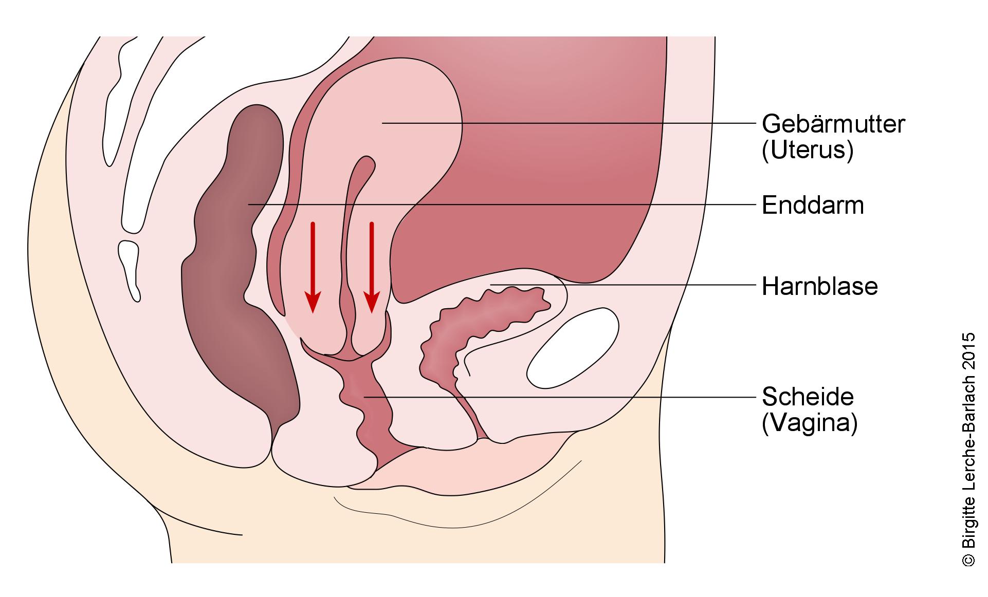 Descensus uteri