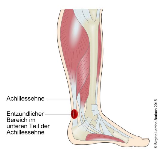 Tendinopathie der Achillessehne