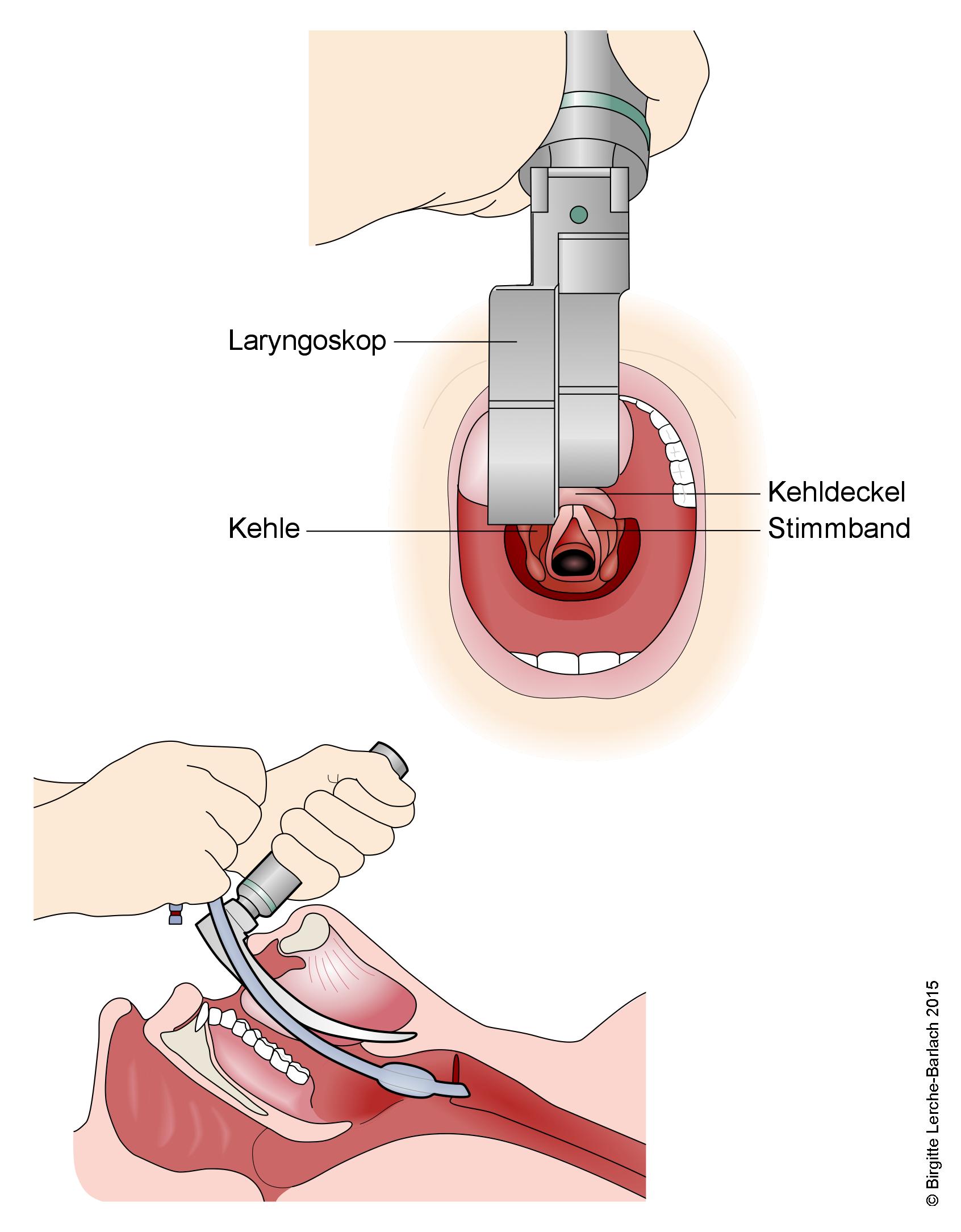 Intubation.jpg