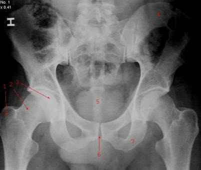 A.p.-Aufnahme eines gesunden Beckens mit Os sacrum und den Hüftgelenken: 1. Trochanter major, 2. Collum femoris (Oberschenkelhals), 3. Caput femoris (Hüftkopf), 4. Os ilium, 5. Os coccygis, 6. Symphyse, 7. Os ischii