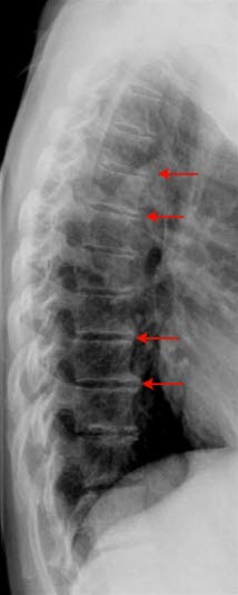 Wirbelsäule mit mäßig ausgeprägter Spondylose