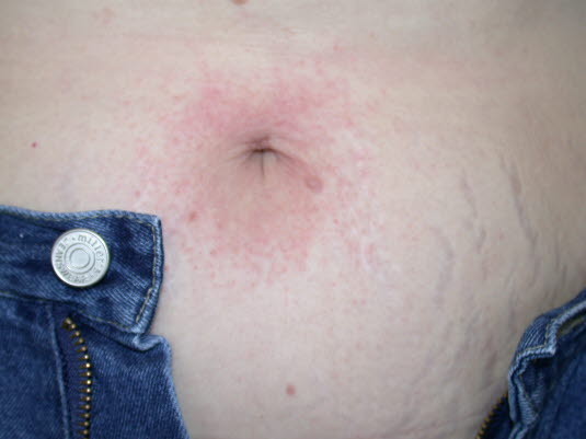 Allergische Kontaktdermatitis