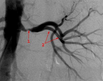 Nierenarterienstenose, Kontraströntgen