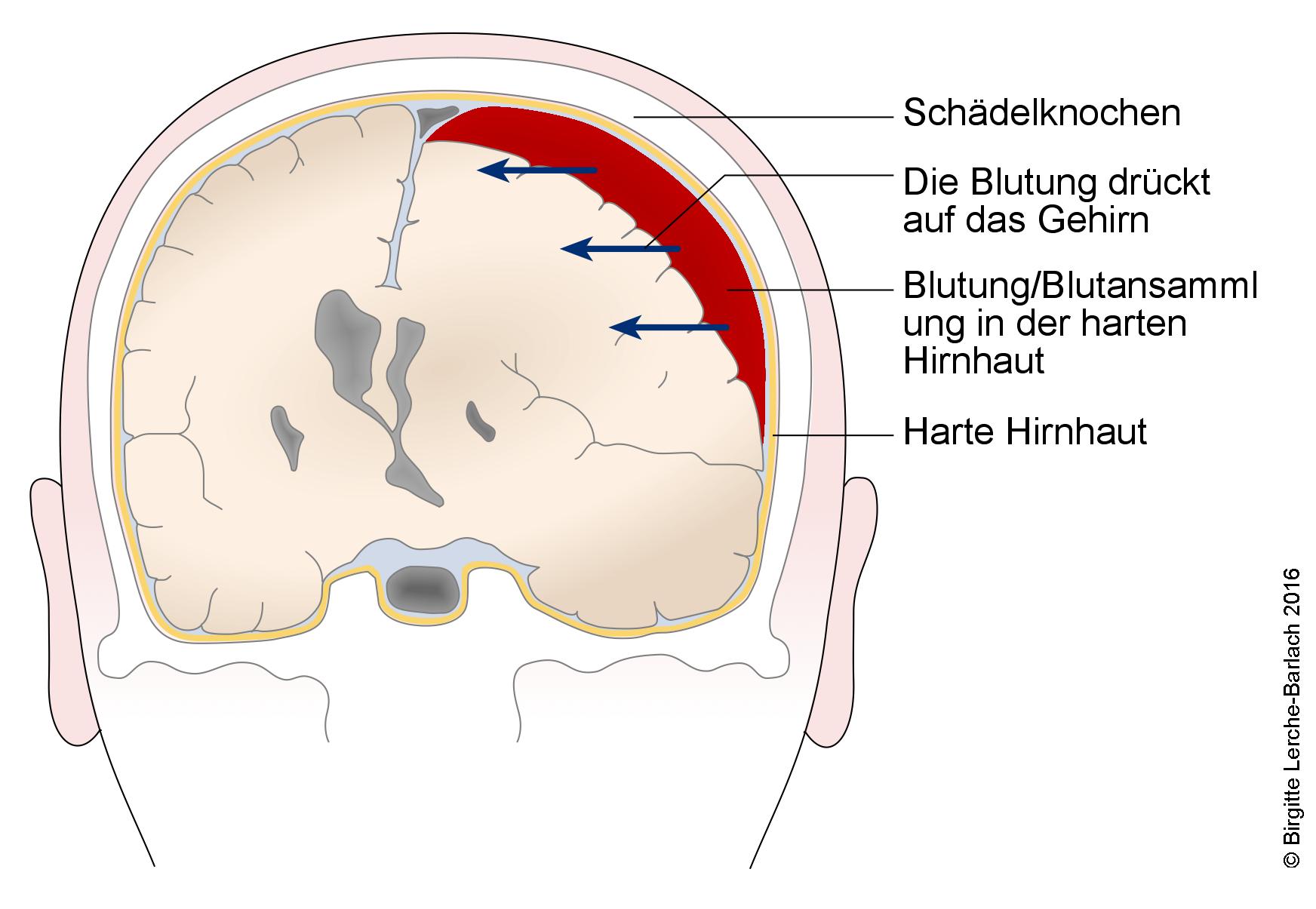 Subdurales Hämatom