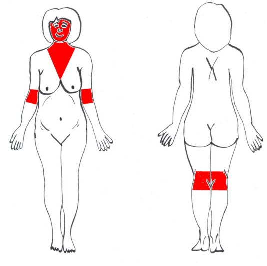 Klassisches Verbreitungsmuster der atopischen Schwangerschaftsdermatose (Quelle: Ugeskriftet.dk, Nachdruck mit freundlicher Genehmigung)