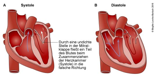 Mitralinsuffizienz