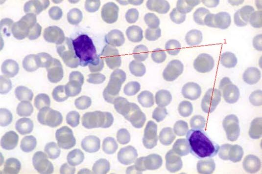 Mononukleose (reaktive Lymphozytose): 1 typische „Mononukleosezellen“ im Blutausstrich