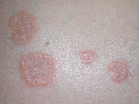 Schwangerschafts-Pemphigoid