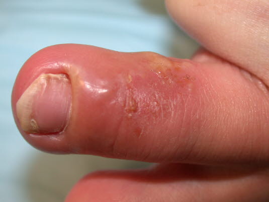 Herpes-simplex-Infektion am Finger (Panaritium)