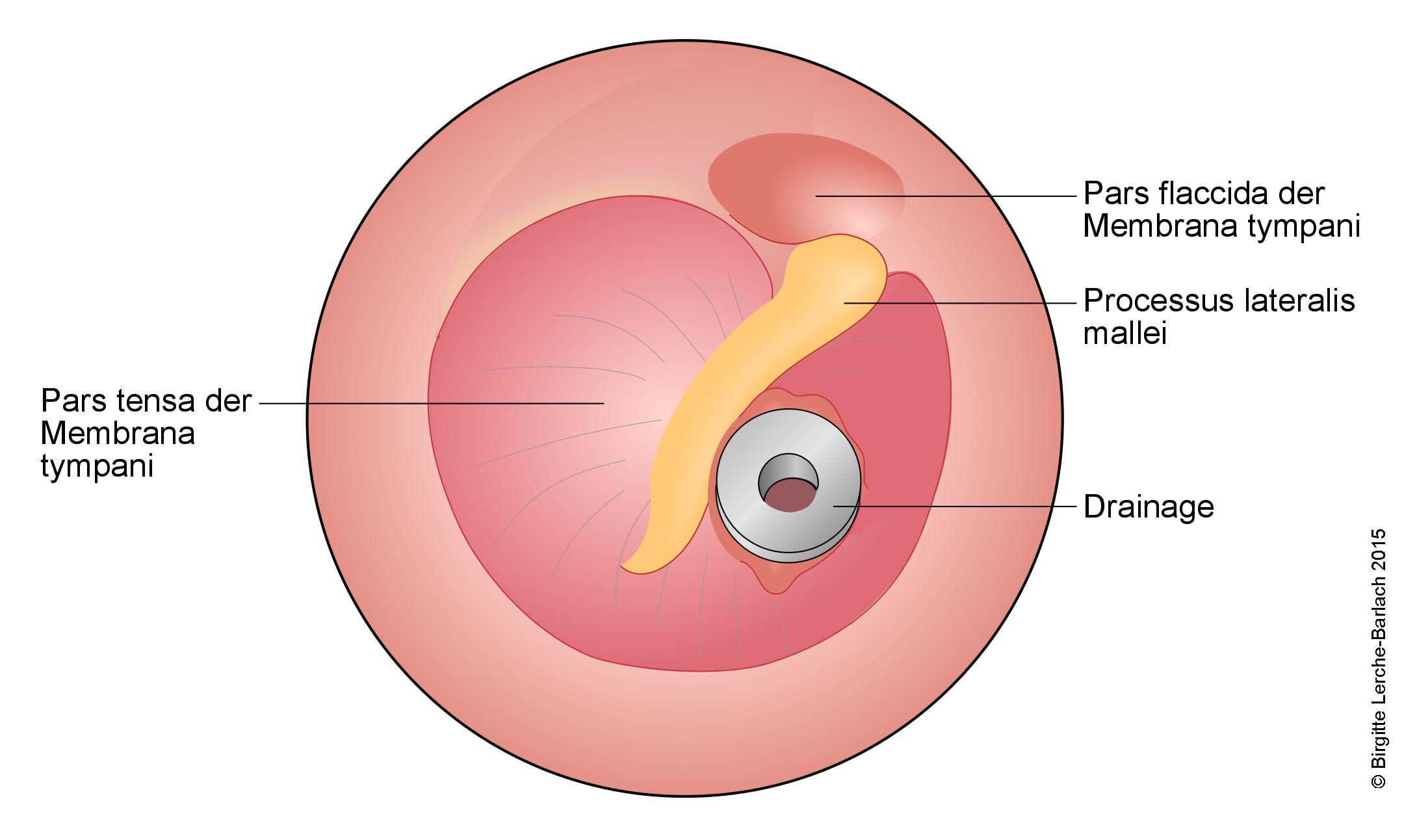 Trommelfell mit Drainage Aussenansicht.jpg