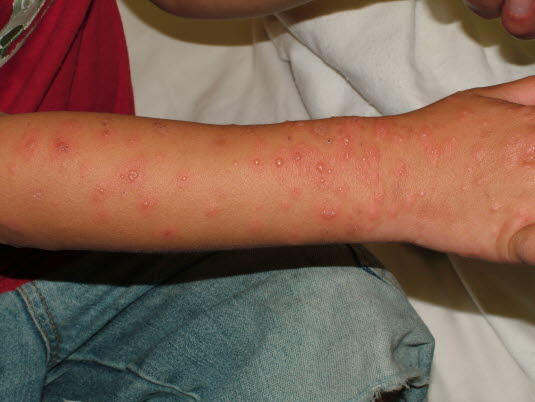 Erythema multiforme, Arm