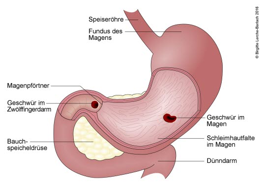 Magen- und Duodenalulkus
