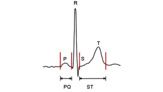 Die verschiedenen Teile des EKG-Komplexes