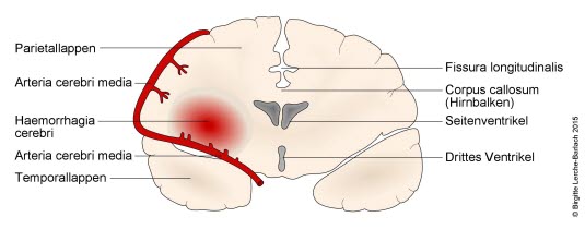 Hirnblutung