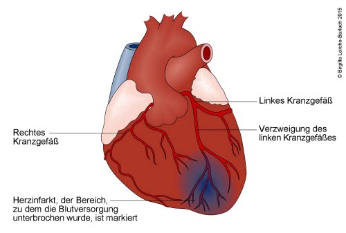 Herz mit Infarkt im Bereich des linken Herzkranzgefäßes