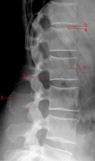 LLendenwirbelsäule seitlich: Dornfortsatz (1), Neuroforamen (2), Bandscheibe (3), Wirbelkörperdeckplatte (4), Wirbelkörper (5).