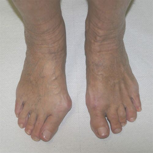 Hallux valgus vor und nach der Operation.