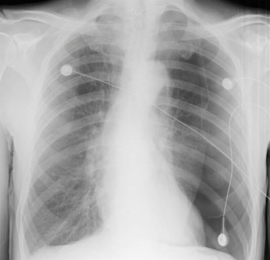 Spontanpneumothorax