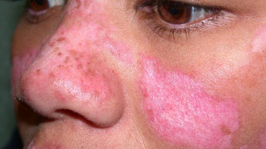 Diskoider Lupus erythematodes im Gesicht