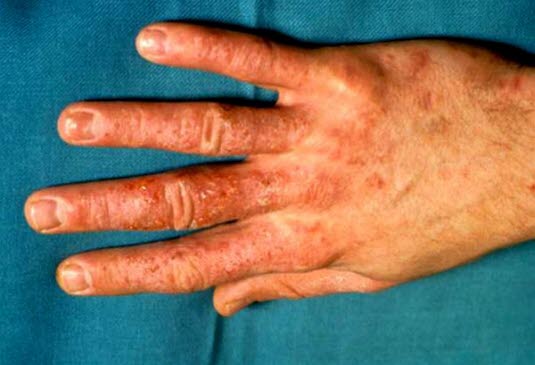 Toxische Kontaktdermatitis