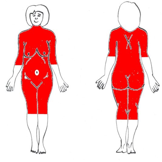 Typische Verbreitung der polymorphen Schwangerschaftsdermatose