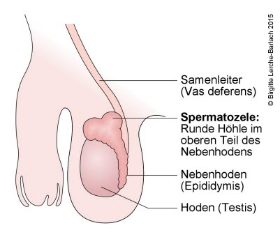 Skrotum, Spermatozele