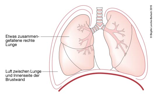 Pneumothorax, partiell