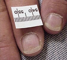 Tüpfelnägel sind durch punktförmige Grübchen in der Nagelplatte gekennzeichnet. Diese liegen bei bis zu 50 % der Psoriasis-Patienten vor.