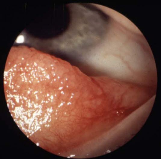 Allergische Konjunktivitis. Häufig ist ein Papillarmuster der Konjunktiva, insbesondere auf der Innenseite des unteren Augenlids, zu beobachten.